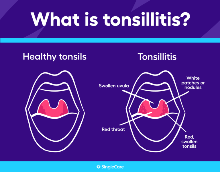 Tonsillitis: Symptoms, causes, and treatments